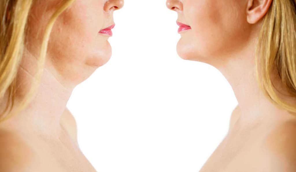Double Chin treatment Bushey before and after results