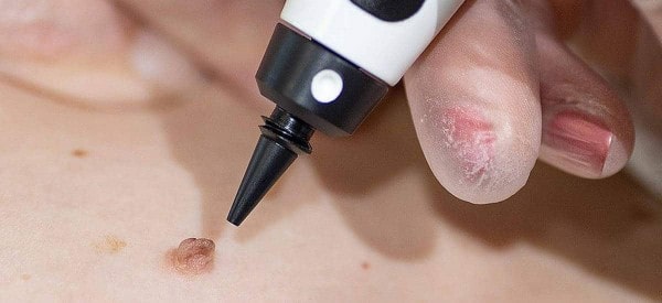 After Skin Tag Removal Bushey