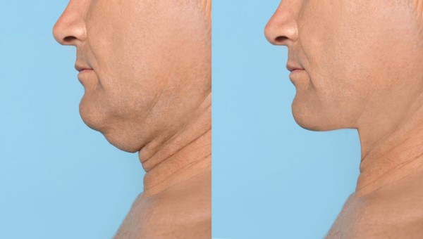 Which Non-Surgical Treatments Work Best for Jowls and Loose Skin Bushey?