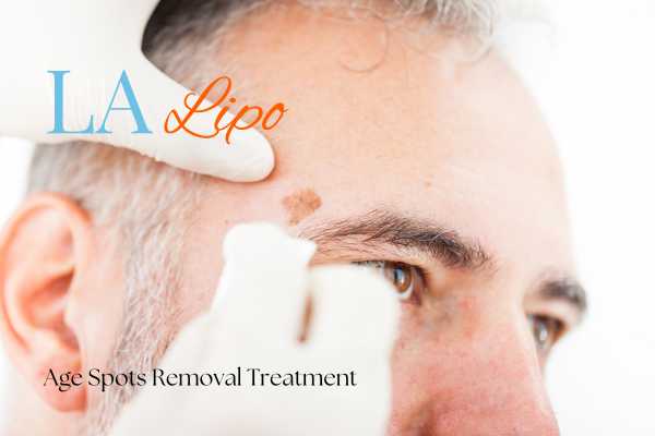 What Are the Most Effective Treatments for Age Spots Bushey?