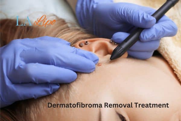 Dermatofibroma Removal Treatment Bushey