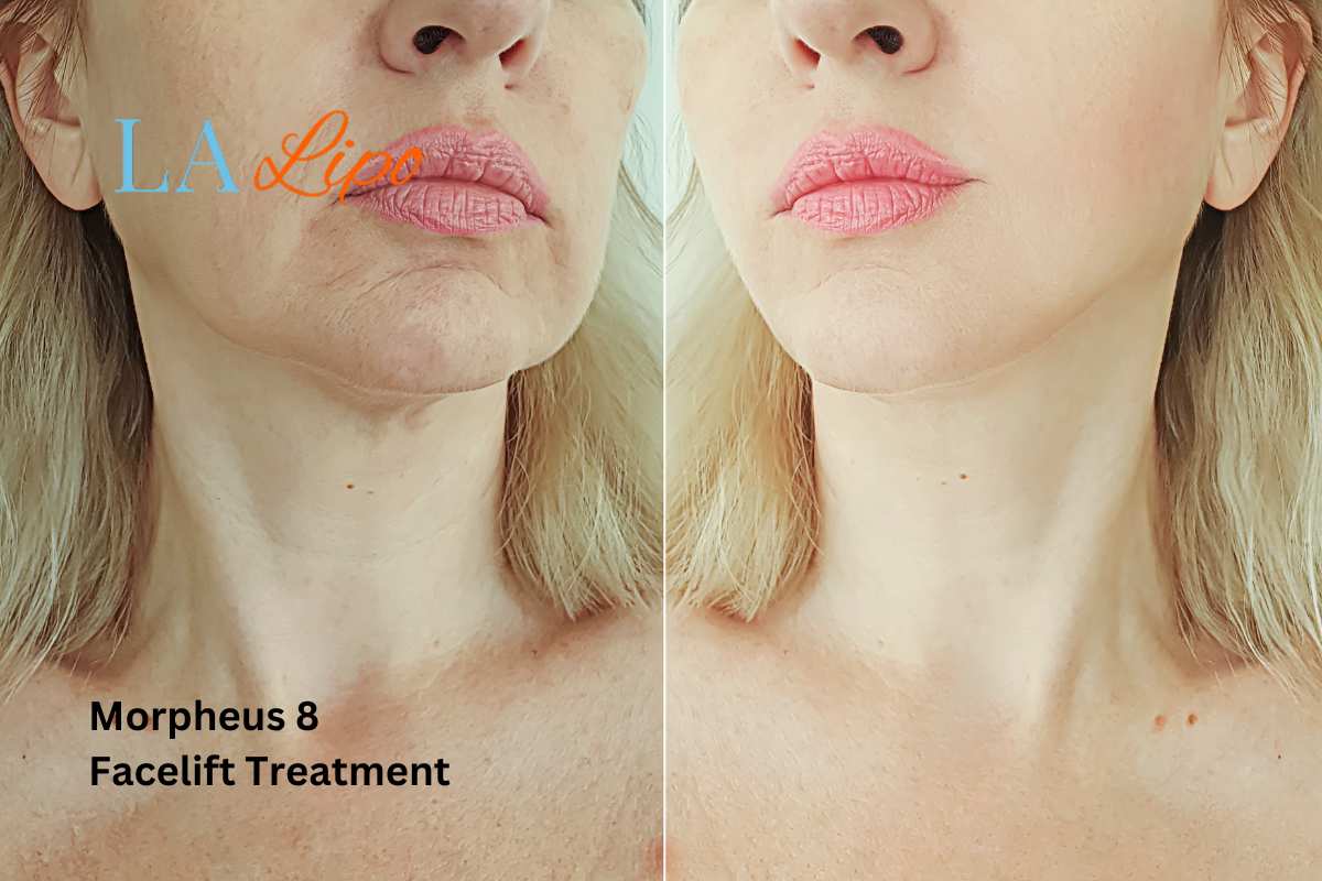 Turn back time with Morpheus8 Treatment Bushey