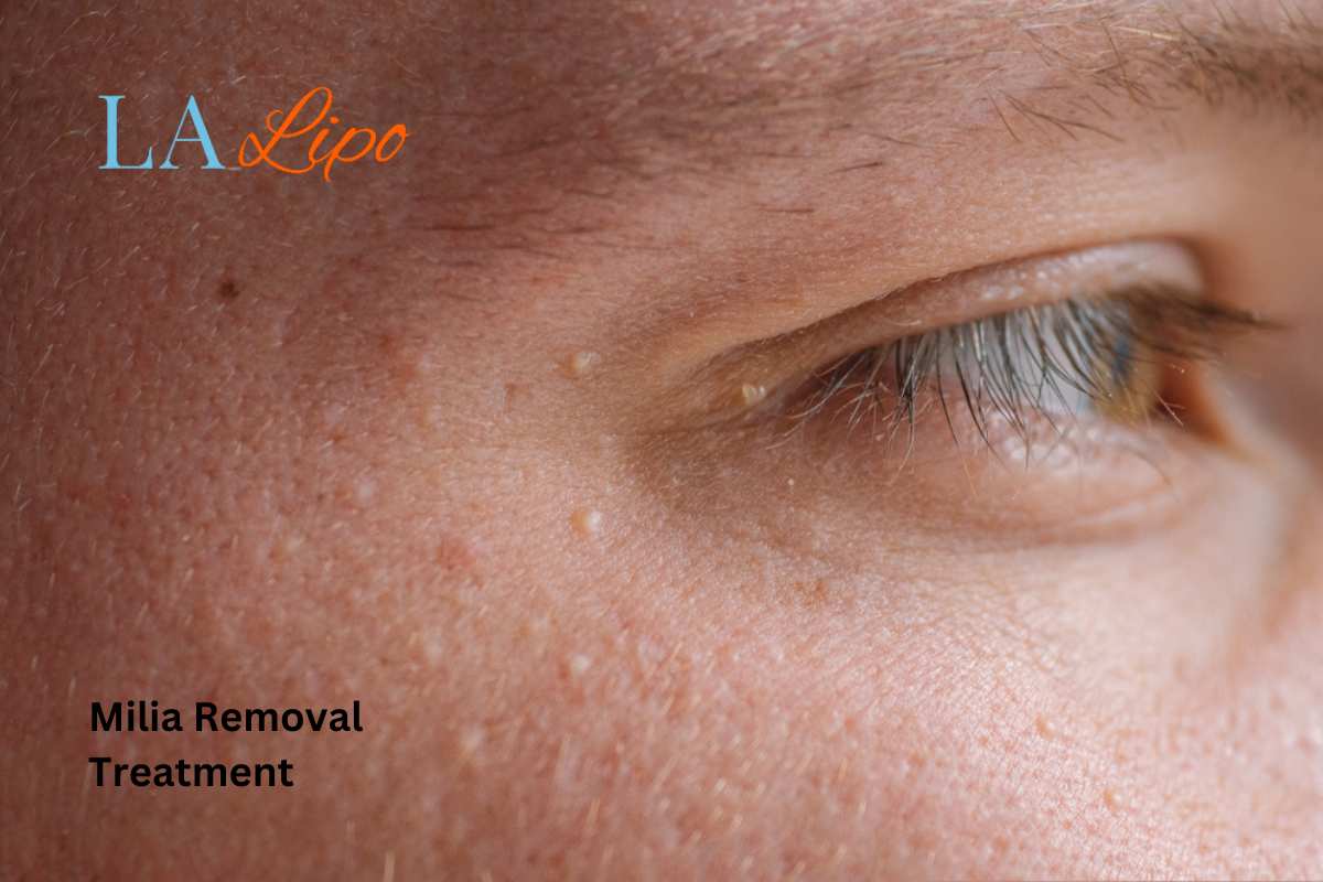 Cryopen Milia Removal: Is It the Easiest and Safest Option Bushey?