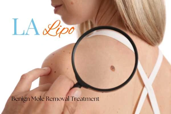 Why getting moles removed Bushey can boost your confidence!