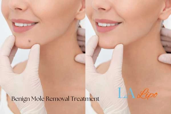 woman's before and after mole removal Bushey results