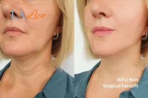 hi-fu for wrinkles Bushey before and after results