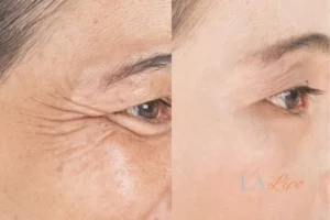 Before and after results of woman - HI-fu wrinkles reduction treatment Bushey