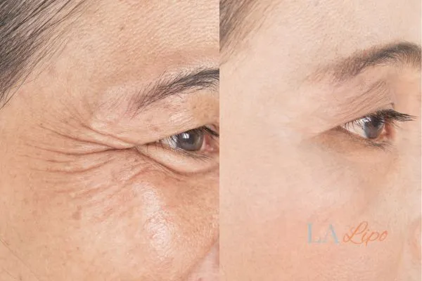 Before and after results of woman - HI-fu wrinkles reduction treatment Bushey