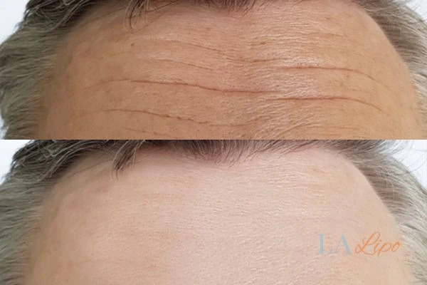 results of HIFU Bushey on mans forehead to help reduce lines and wrinkles