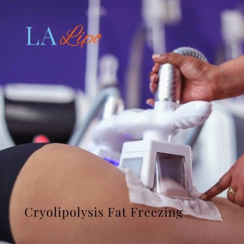 fat freezing - Cryolipolysis Bushey