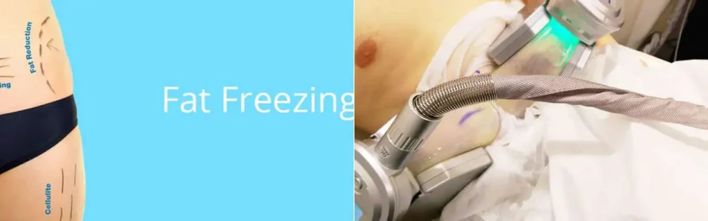 multi areas of a persons body having coolsculpting Bushey treatment