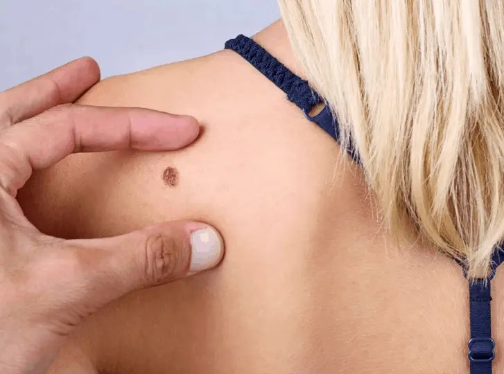 woman having mole removal Bushey consultation before treatment.