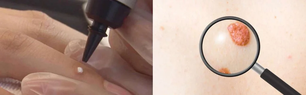 Person getting moles removed with cryopen Bushey
