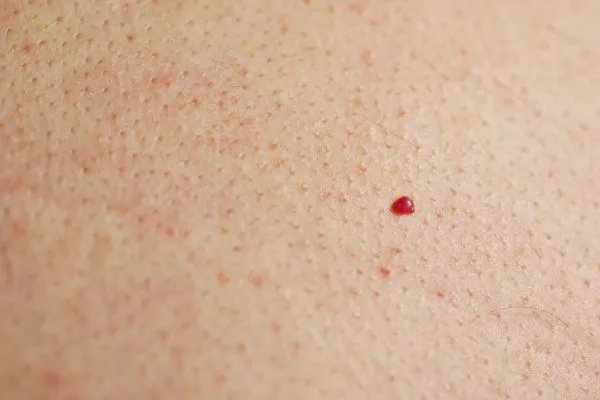 close up of a cherry angioma Bushey