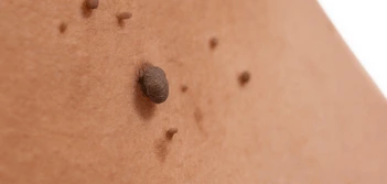 image of a skin tag Bushey