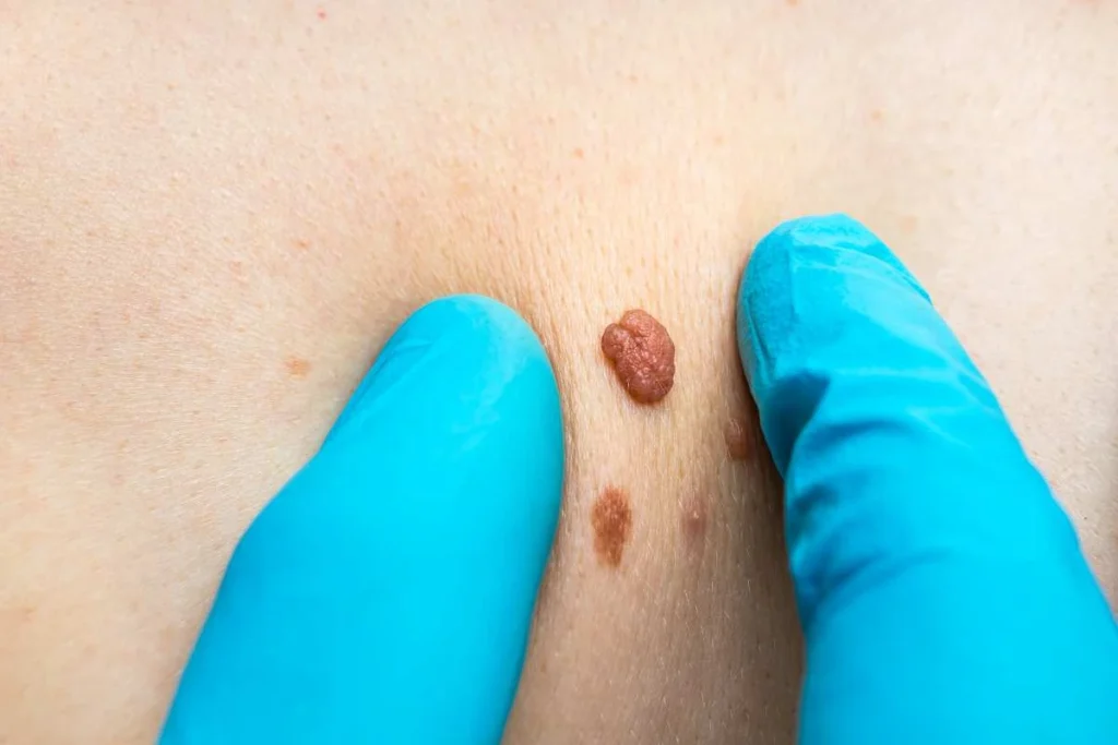 Consultant examining a skin tag Bushey