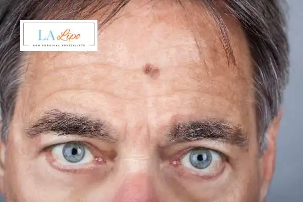 Solar Lentigo Removal Bushey image of man with mark on his forehead