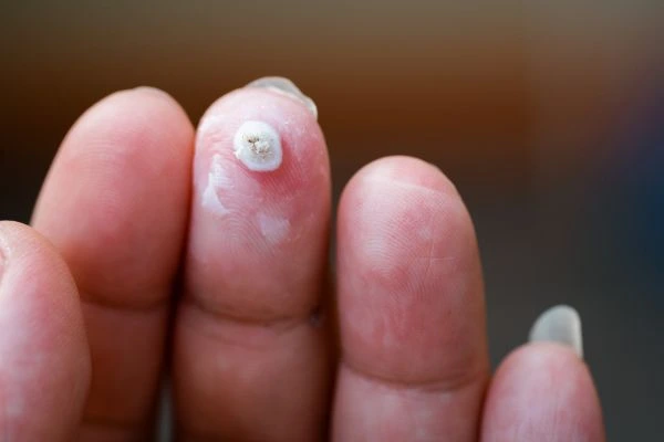 wart on person finger - cryotherapy to treat from LA LIPO Bushey