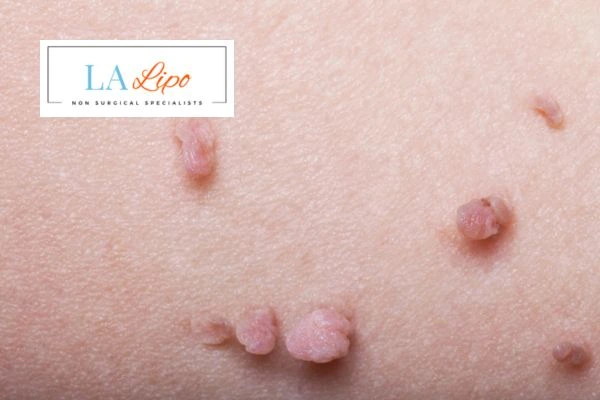 Does cryopen skin tag removal Bushey hurt? Find out now call our team today!