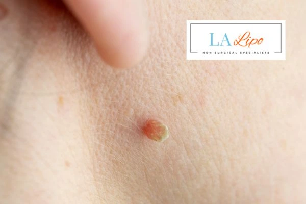 Book skin tag removal Bushey today speak to our team now!