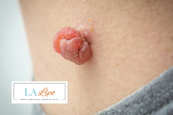 Interested in skin tag removal Bushey? Concerned about the pain? Find out more today!