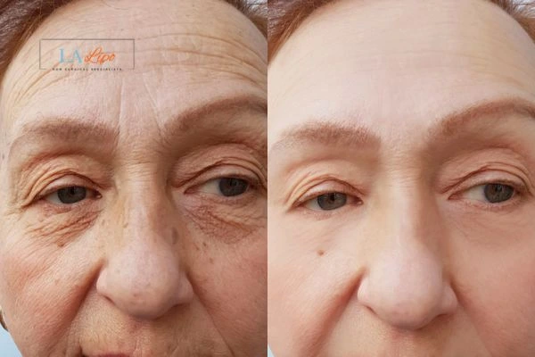 The powerful benefits of Morpheus8 Treatment Bushey - Call Our team today!