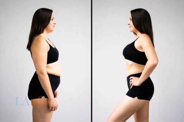 Picture of womans before and after using LA-EMS body sculpting to improve her core strength Bushey