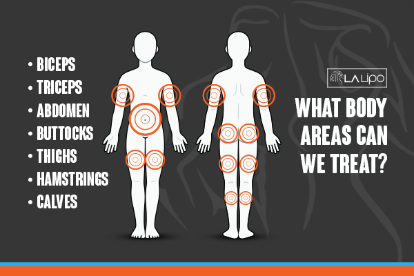 Diagram to show areas you can have LA-EMS Body Sculpting Treatment Bushey