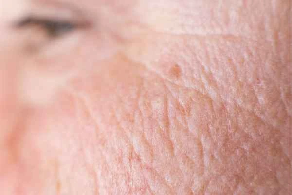 close up picture of a woman's face showing an age spot Bushey