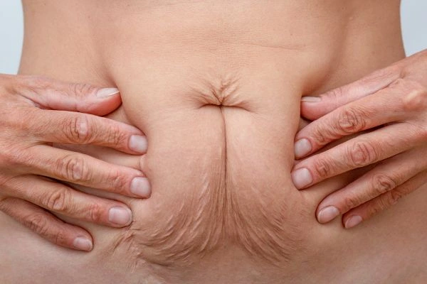 Image of a woman's stomach with loose skin - example of skin tightening Bushey options