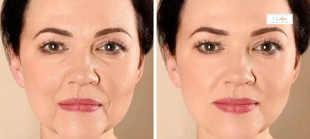 How Long Does It Take to See Results and How Long Do They Last Bushey?