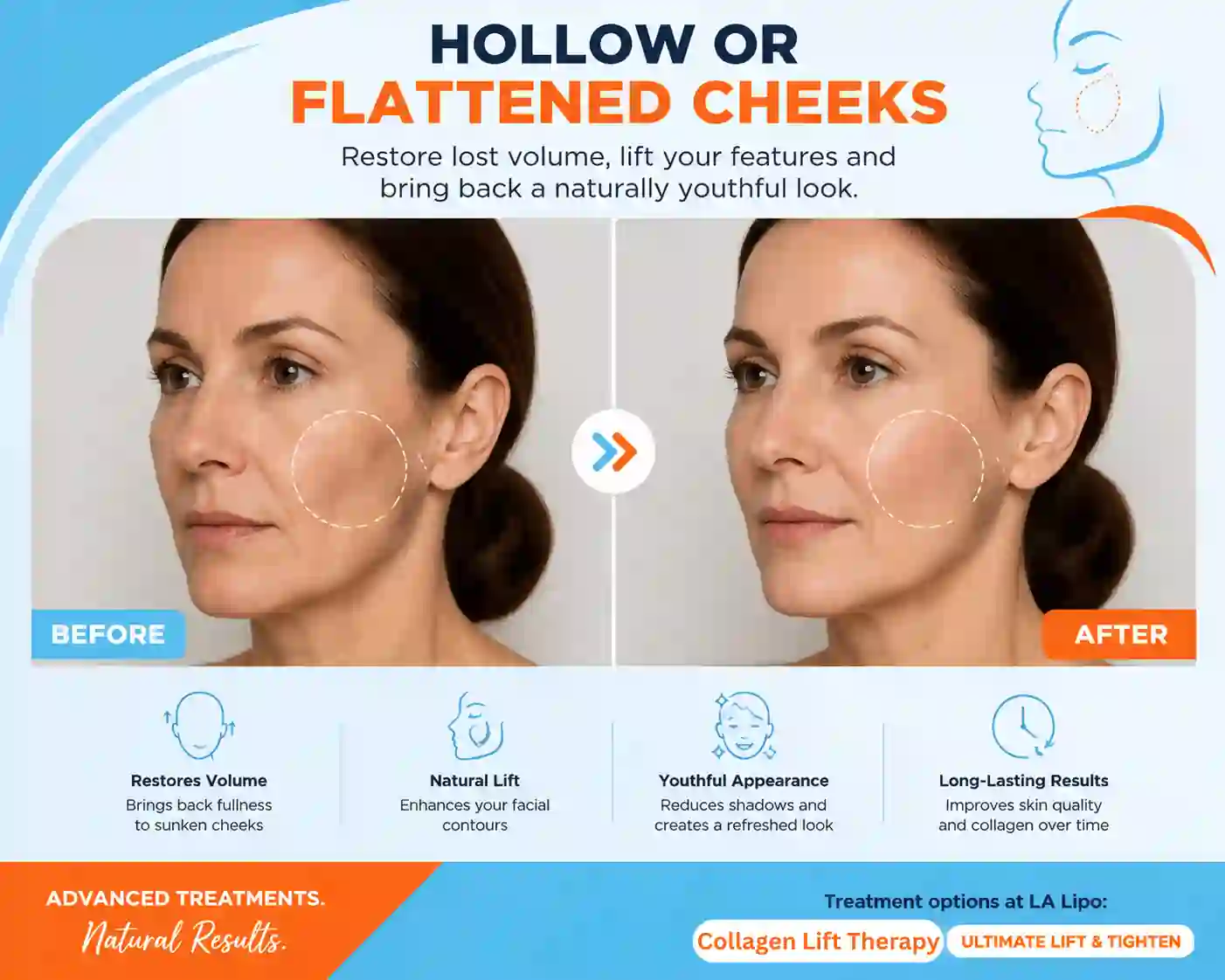 Sign #4: Hollow or Flattened Cheeks Bushey
